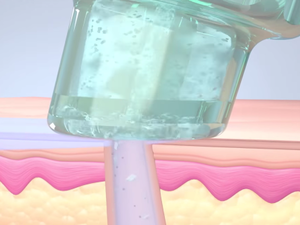 Step 3: VACUUM EXTRACTIONS